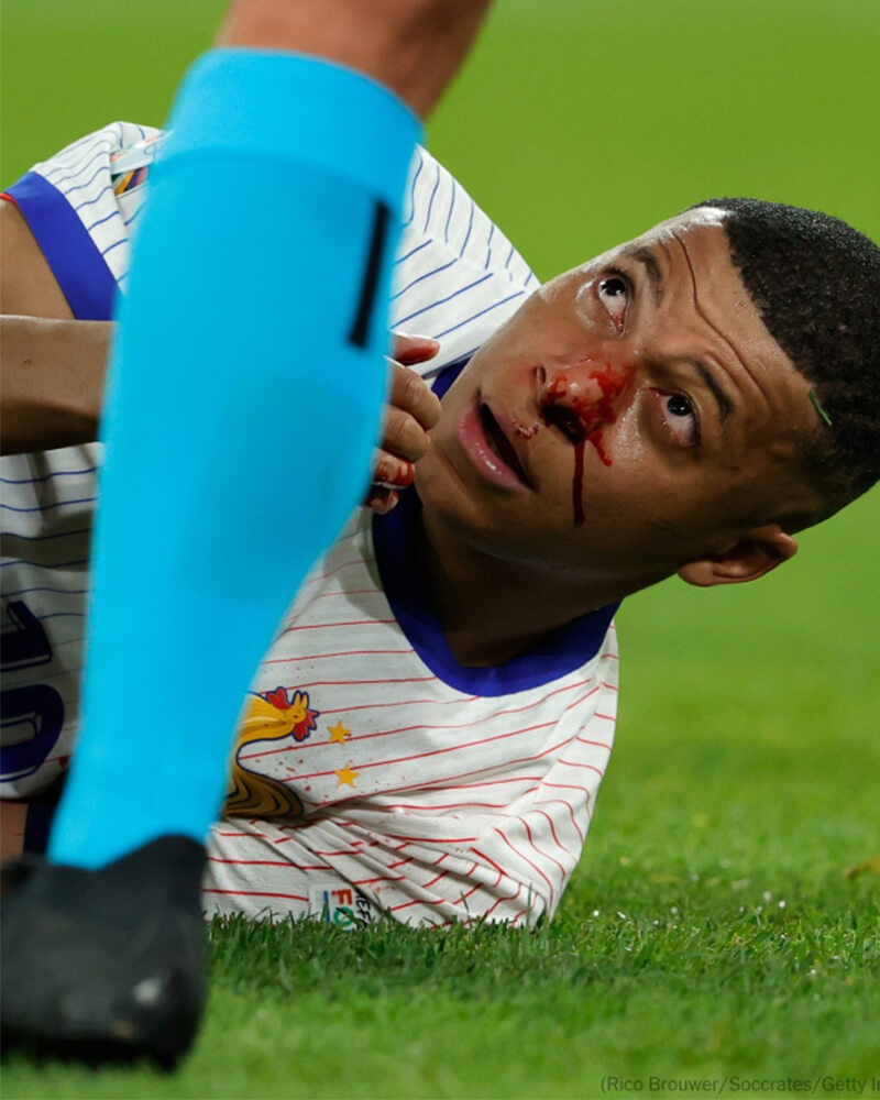 Mbappé Suffers Facial Injury in Tense France Win
